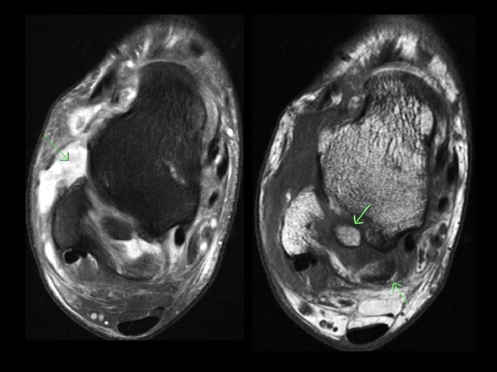 Figure 2 for case posterior ankle impingement
